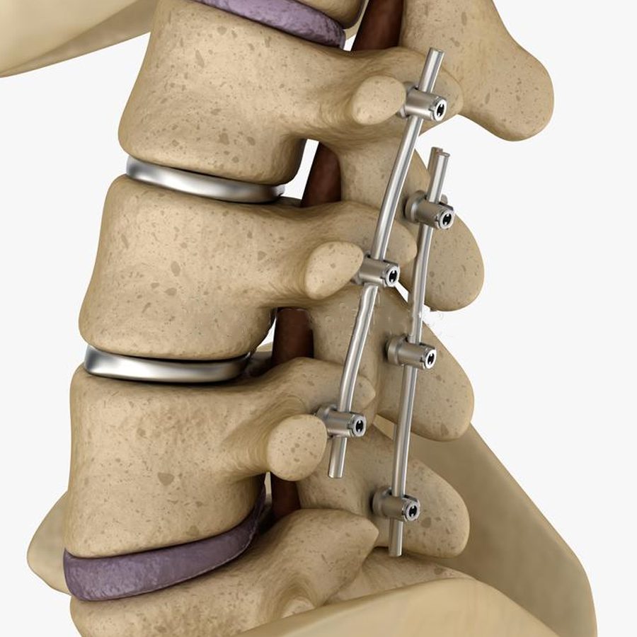Artrodese cervical