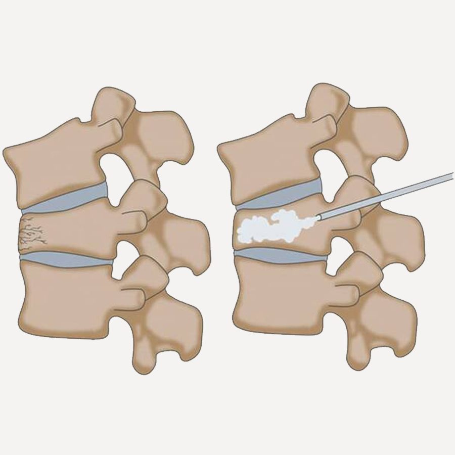 Cifoplastia e Vertebroplastia