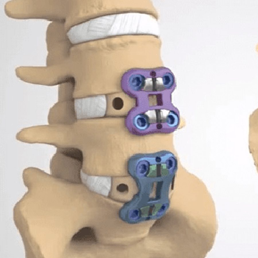 Artrodese cervical