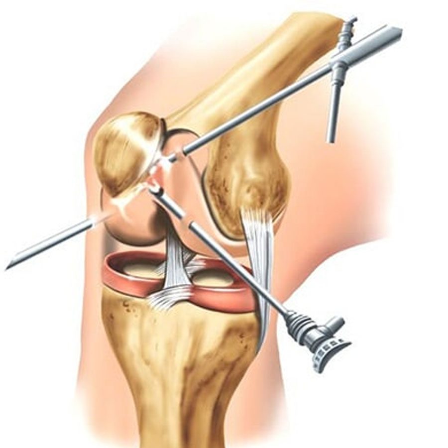 Ligamentoplastia (joelho)