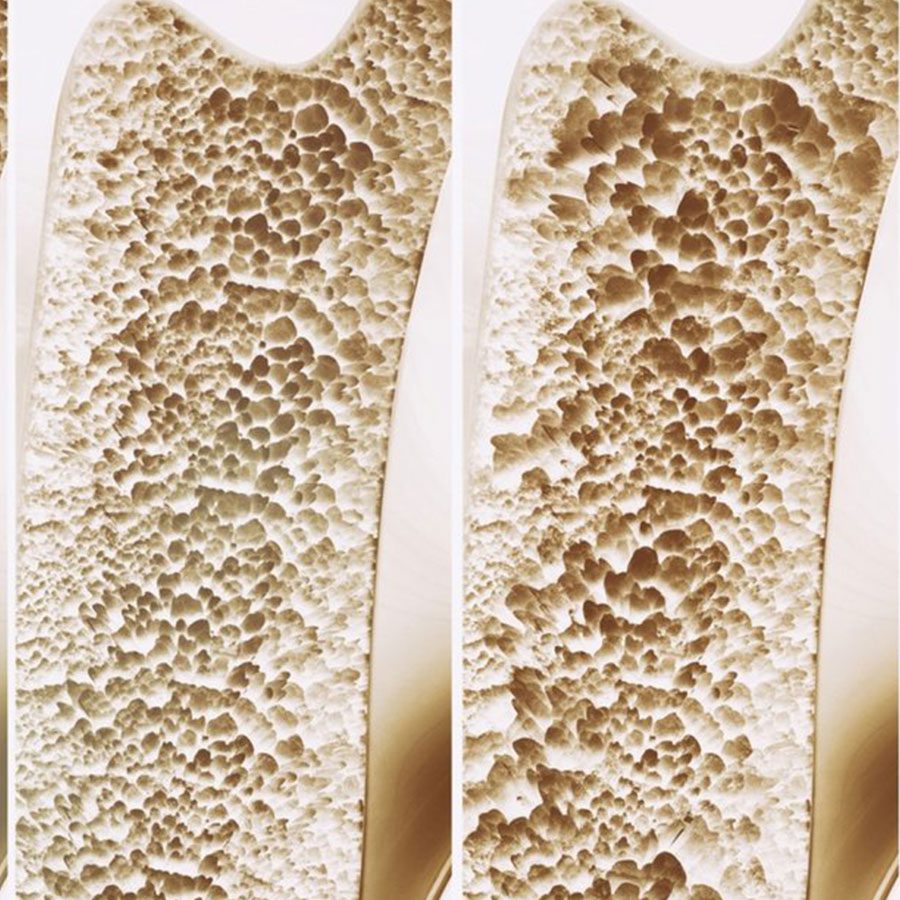 Osteoporose