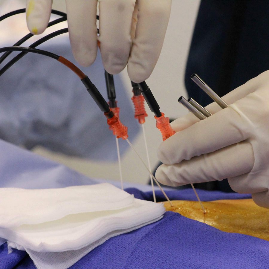 Rizotomia por radiofrequência